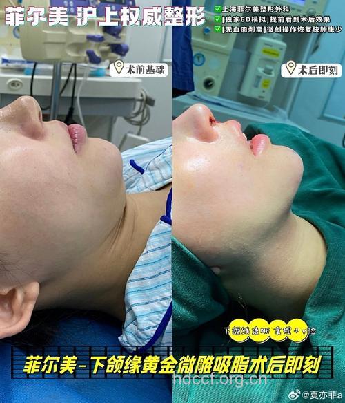 新年赶走双下巴 吸脂手术来帮你