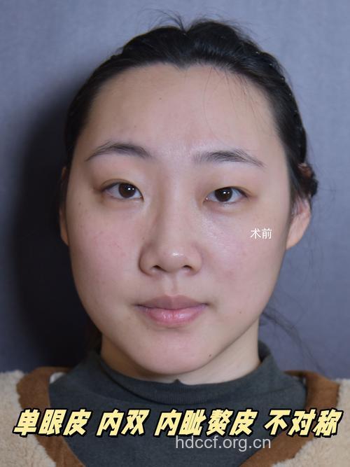 细扒那花里胡哨的双眼皮整形 寒假整形别上当