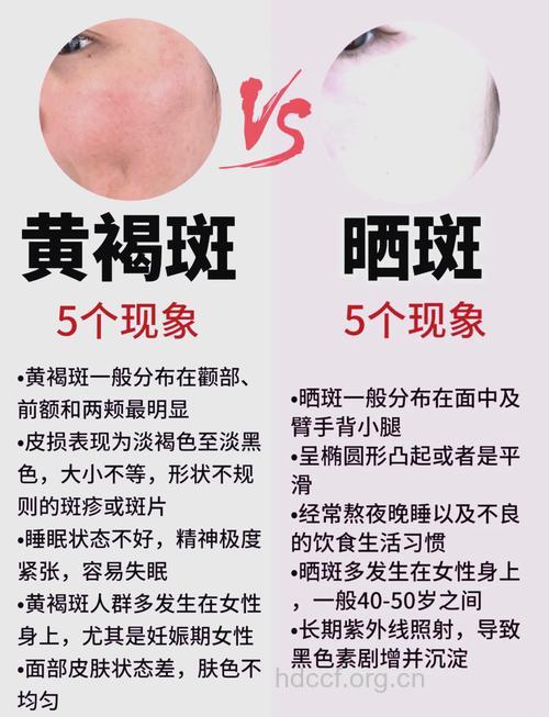 日晒是长斑的罪魁祸首