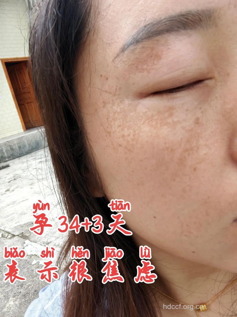 怎样消除怀孕时长的黄褐斑