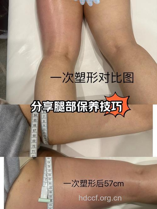 亚洲喜欢整腿部 揭不同洲流行的整形项目