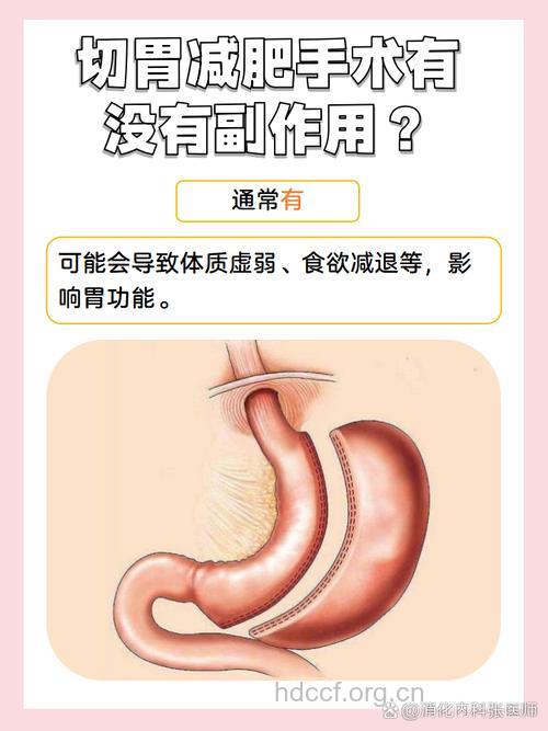 一家9口切胃减肥 切胃减肥人人能做吗