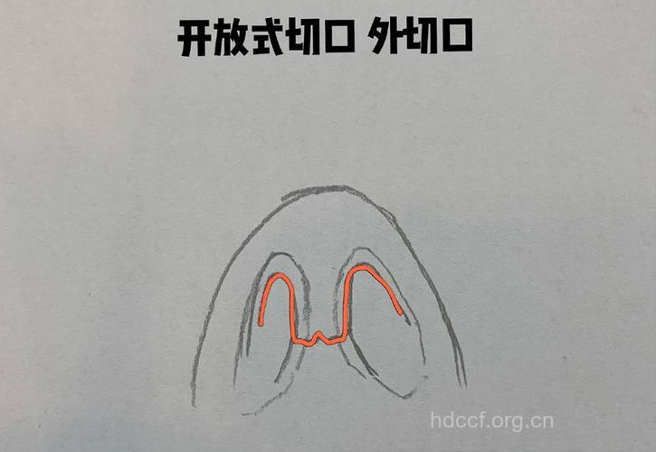 怎样选择隆鼻术的切口