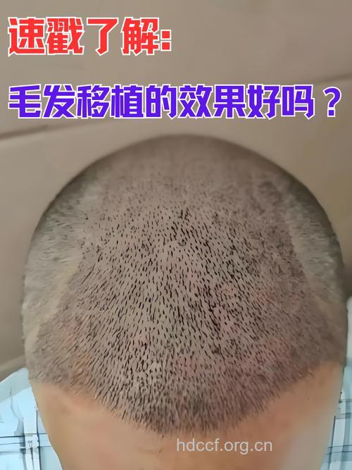 毛发移植的常见问题