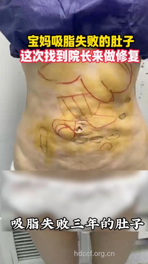 女子打溶脂针减肚腩引起腹部溃烂