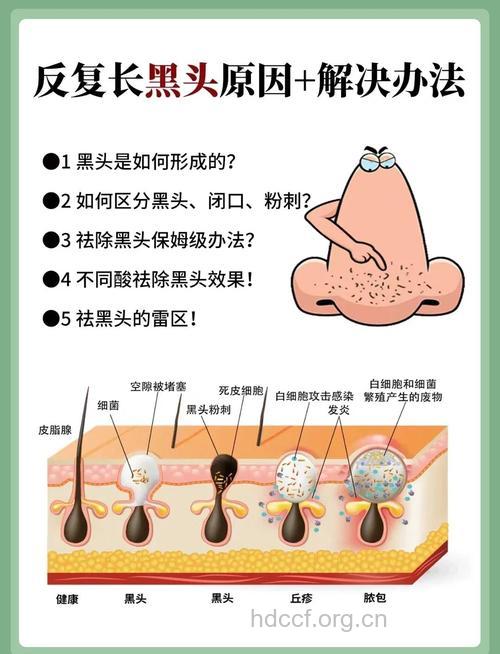 揭秘草莓鼻形成的原因