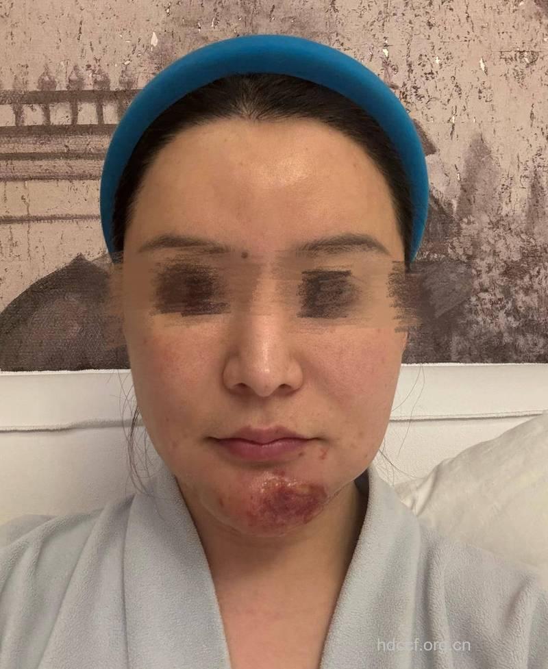 女子花万元整容致脸部化脓 面部整形有哪些危害