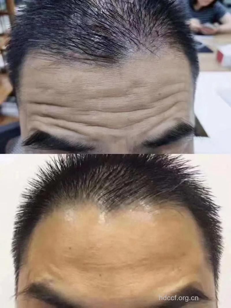 男人为何要除皱