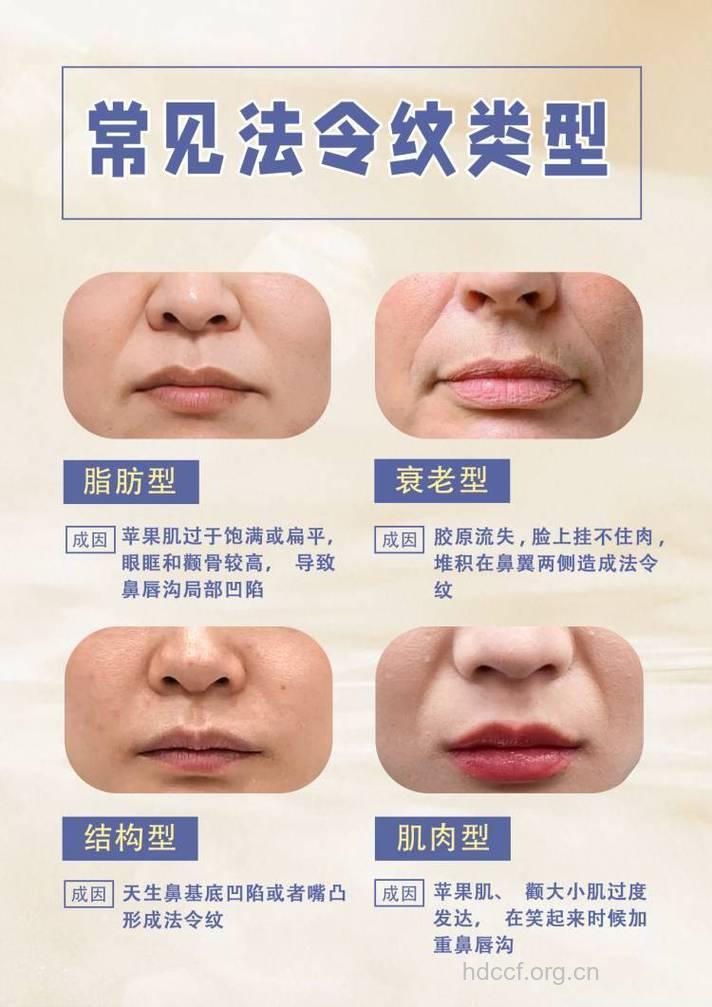 暴露你年龄秘密的法令纹