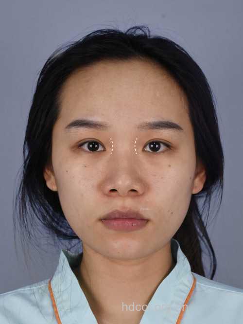 中国人为何会恋上＂韩式隆鼻'