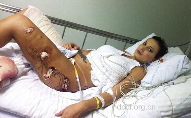 巴西名模臀部整形导致腐烂