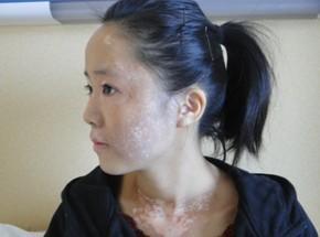 女子减肥减出白癜风