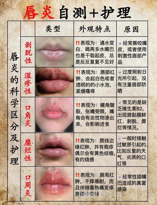 怎么防治唇边红肿痘痘方法