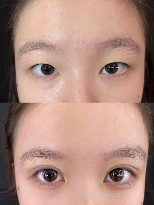 “连续埋线式”双眼皮手术的效果怎么样