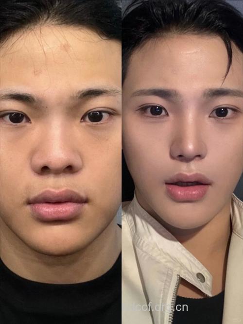 男人也爱上整形