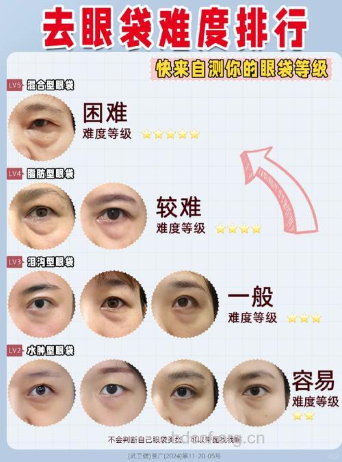 哪个年龄段适合祛眼袋