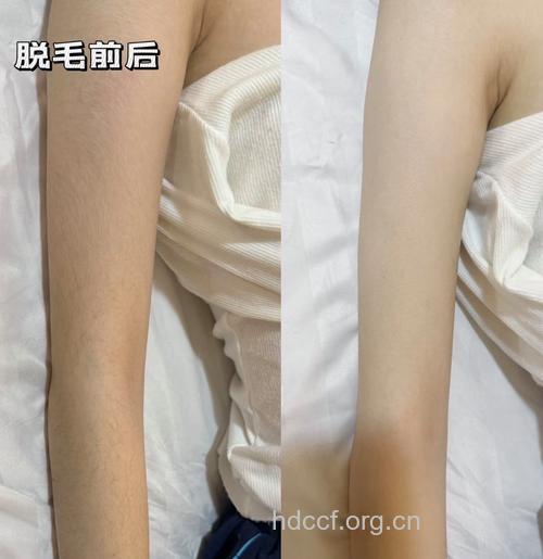 全身光子脱毛好不好