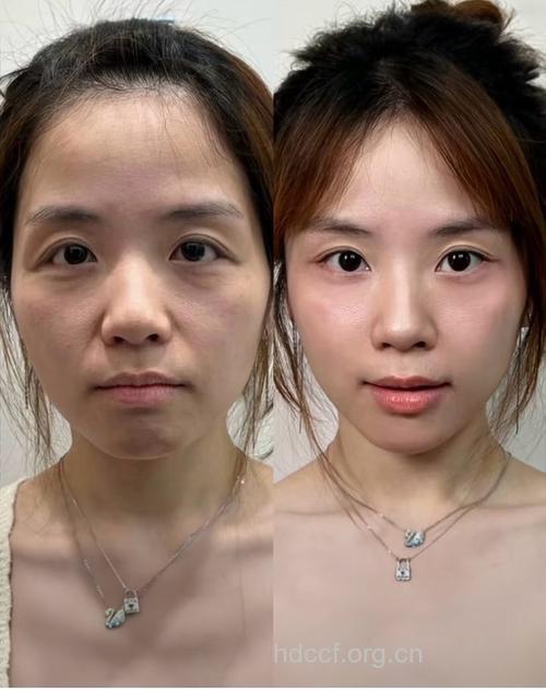 微整形让你悄然无息变美人