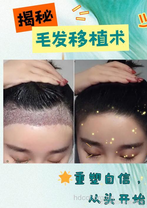 头发也能做移植