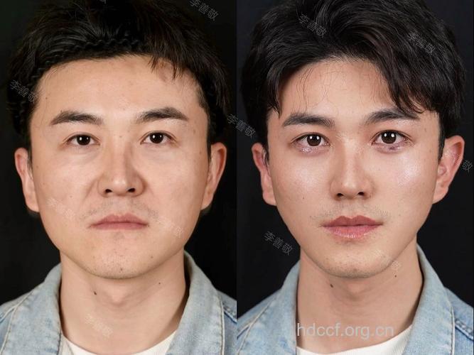 盘点 男人最应该整形的几个部位