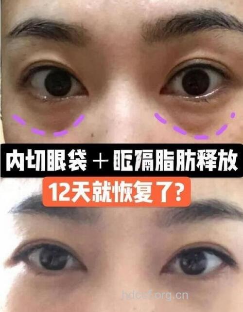 揪出眼袋出现的5个内因