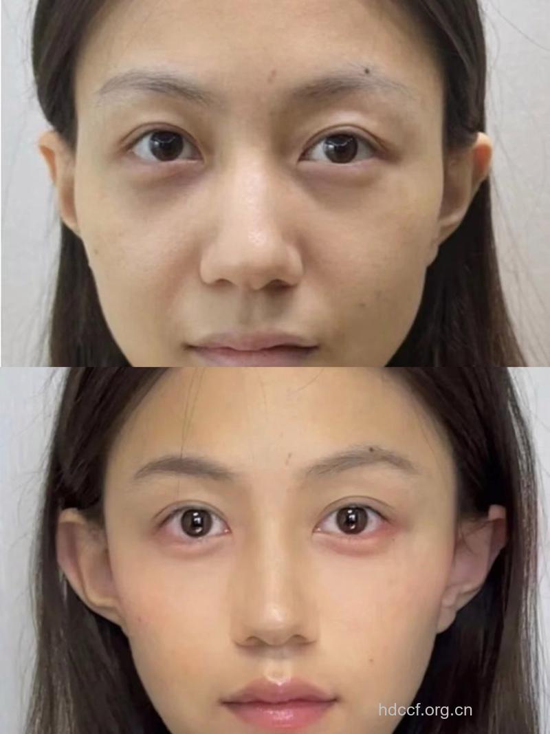 3种微整形 让美丽不知不觉