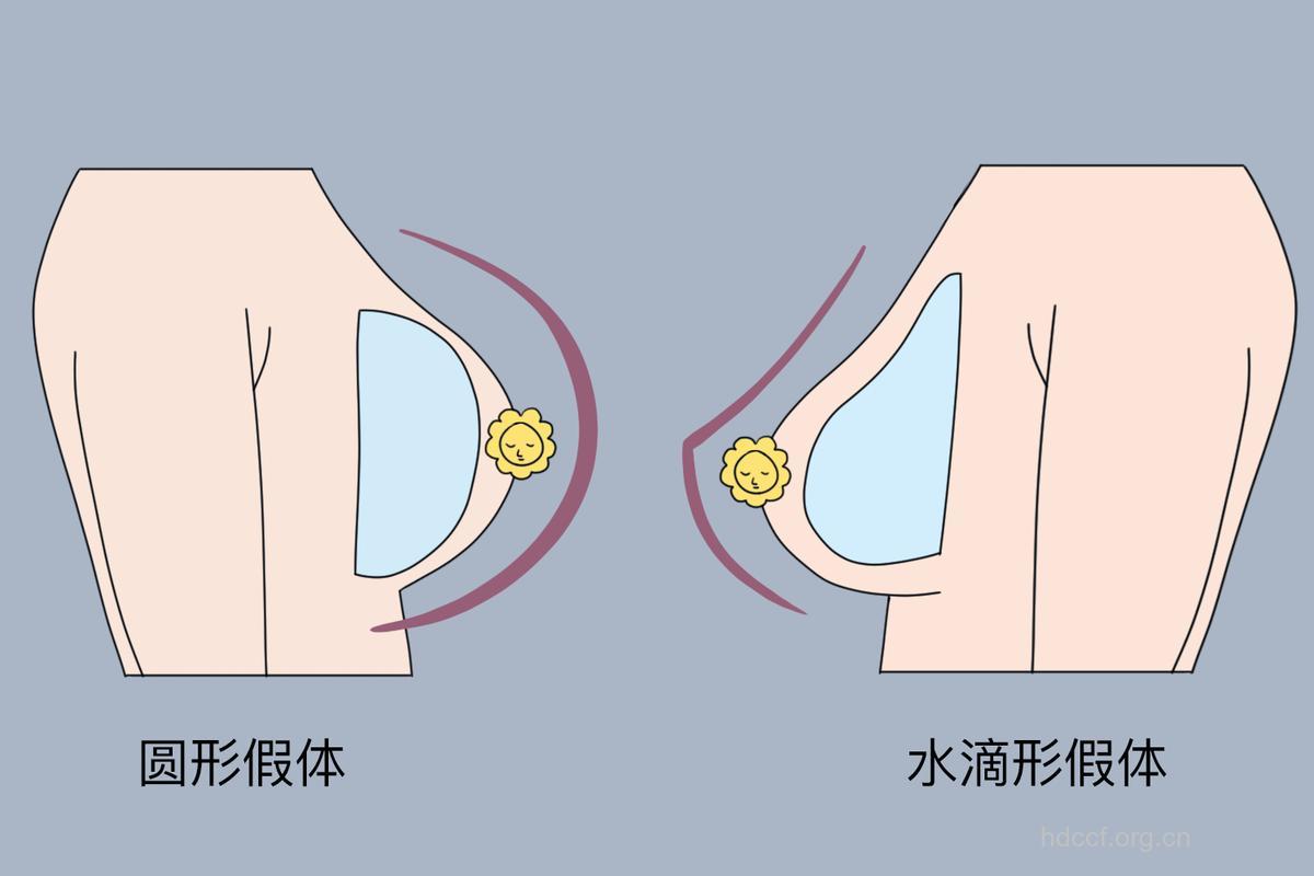 乳晕整形 让乳房更唯美