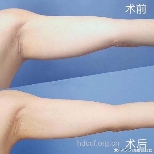 冷冻溶脂瘦手臂 不一样的减肥方式