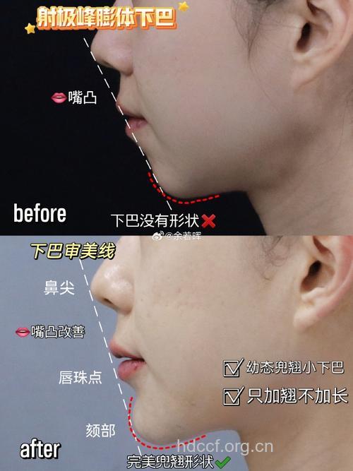 膨体隆下巴 刻画娇翘迷人下巴