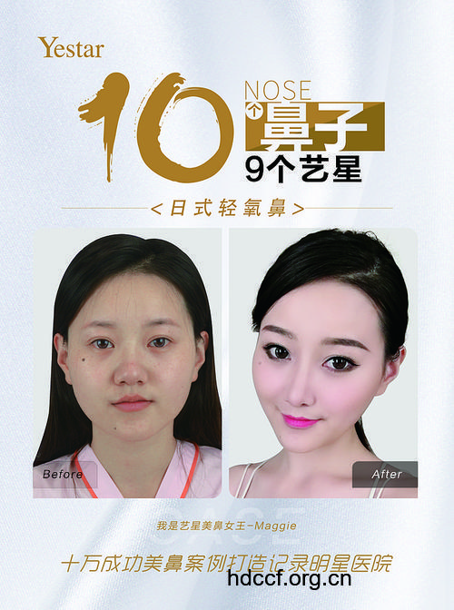 韩国BSK宫廷隆鼻 鼻尖上的美学