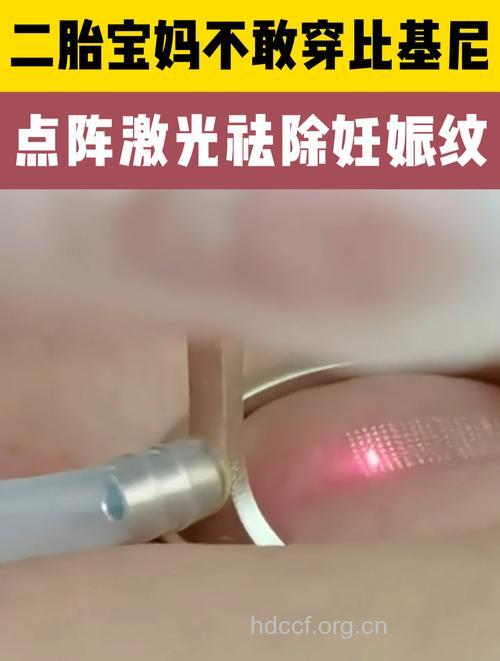 妊娠纹太难看 5种激光仪器帮去除