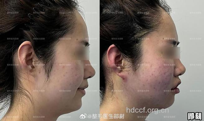 专家答疑：面部吸脂会不会留疤？