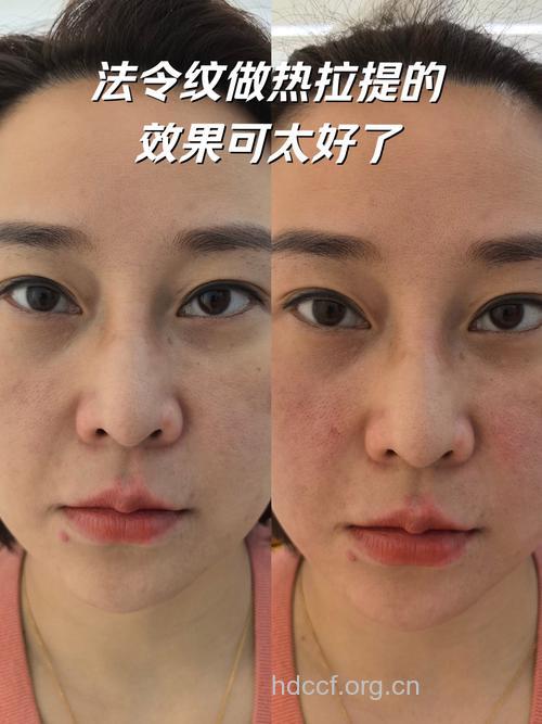 热拉提：改善你衰老的容颜