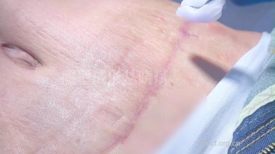 整形手术后要当心 伤口最怕出现这些情况