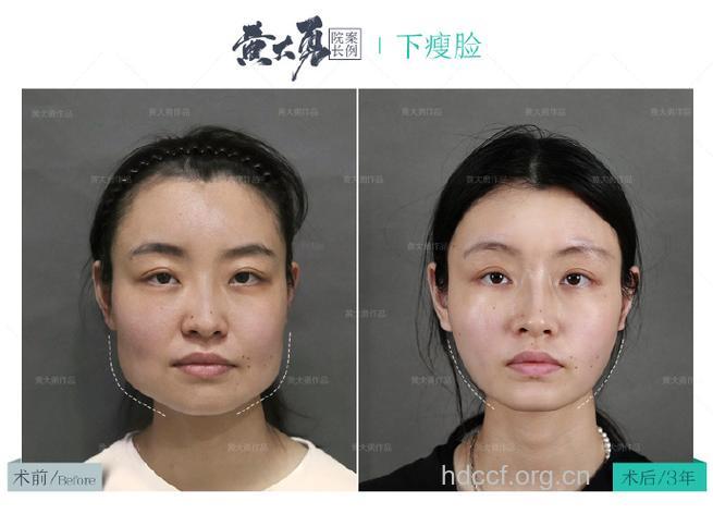 下颌角磨骨瘦脸手术后需注意四点