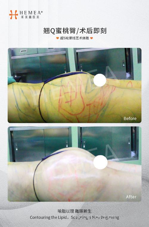 未成年人适合做臀部吸脂手术吗？