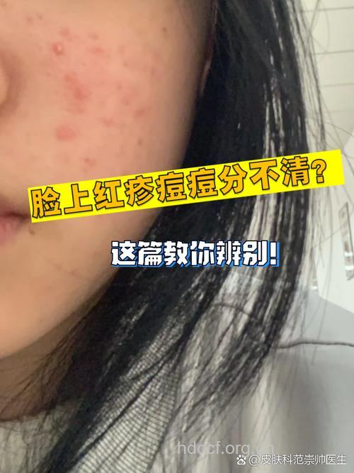 脸上长小红点不痛不痒是什么原因 如何祛痘