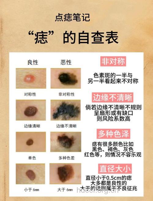激光点痣会不会留疤 如何才能不留疤