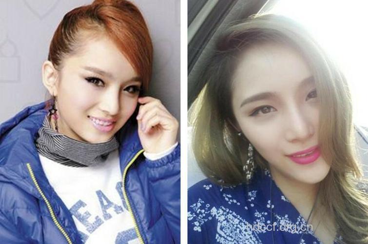 快女整容成畸形锥子脸 网友惊呆