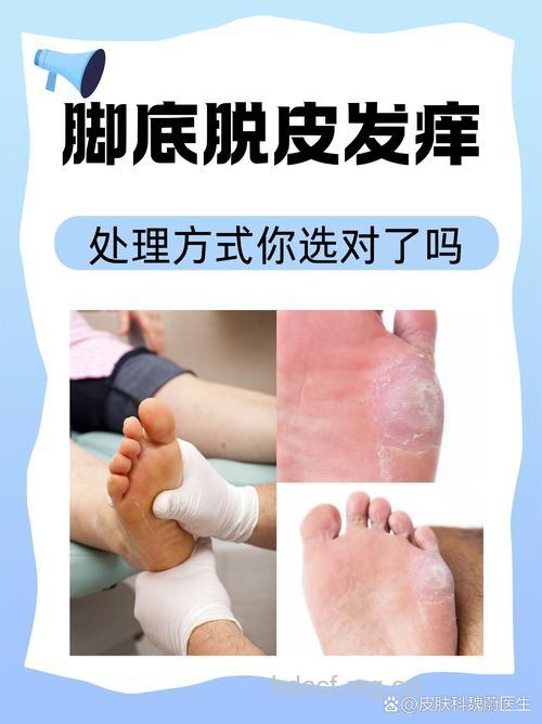 女性脚部皮肤发痒怎么办