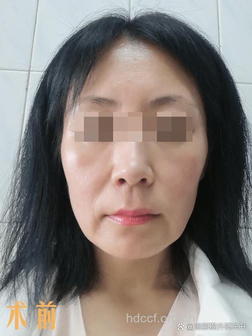 王菲现拉皮后遗症 脸部线条僵硬(图)