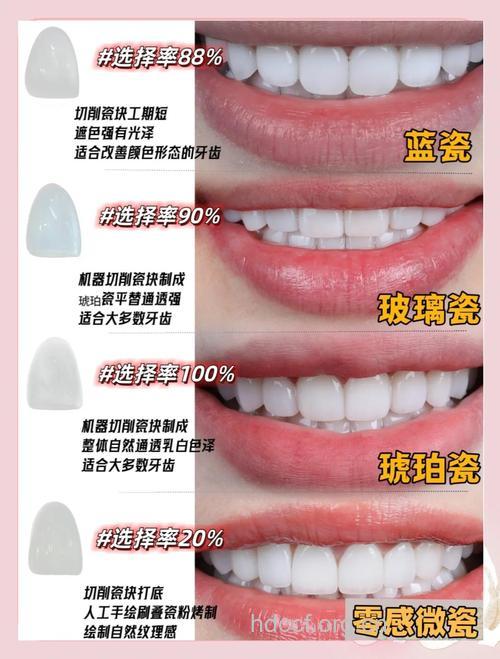 瓷贴面 牙齿贴面使用的三种材料