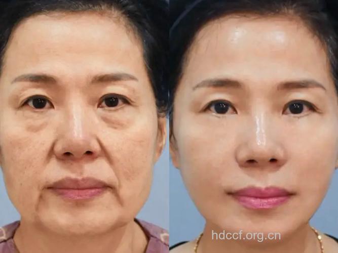 光波除皱让女人变的年轻