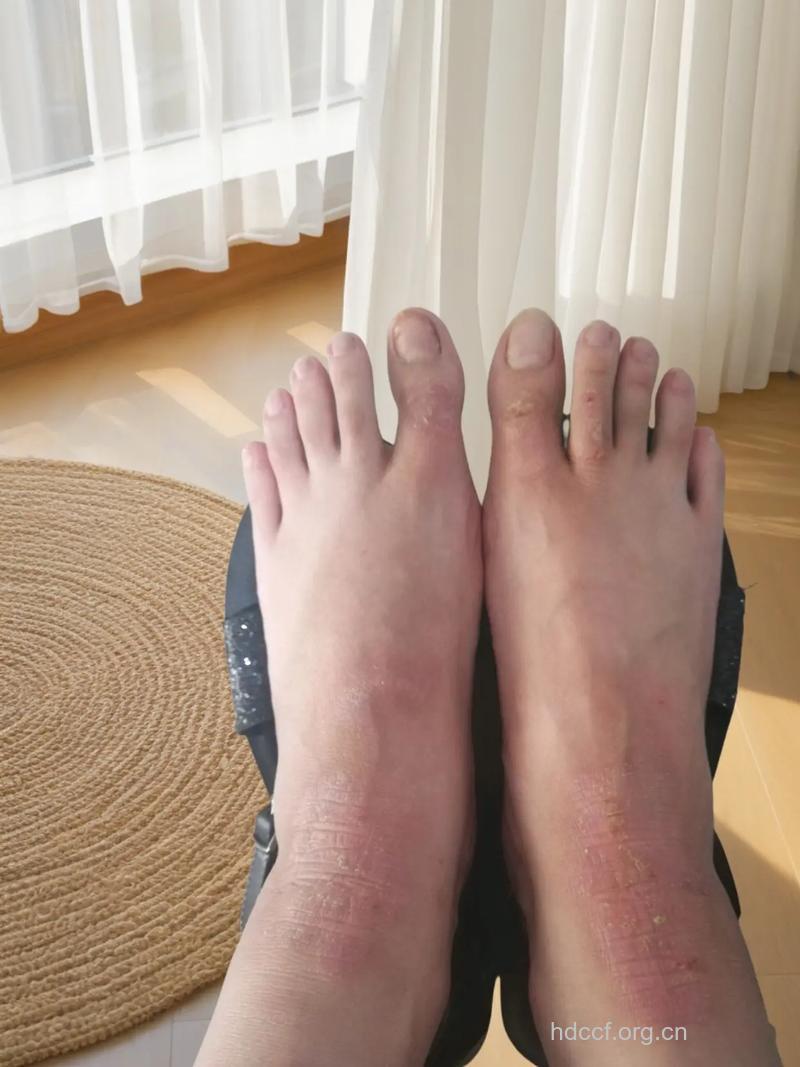夏季穿凉拖鞋易患皮肤癌