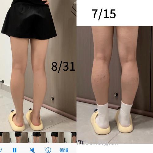 瘦小腿 吸脂好还是瘦腿针好