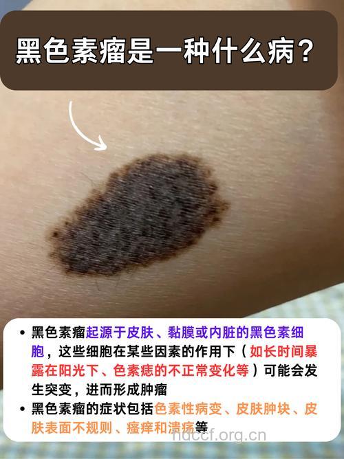 “室内美黑”会上瘾 引发黑色素瘤易患皮肤癌