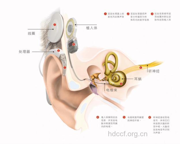 人工耳蜗手术的适应范围