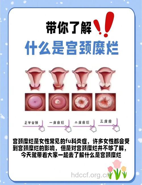 宫颈糜烂的都有哪些危害