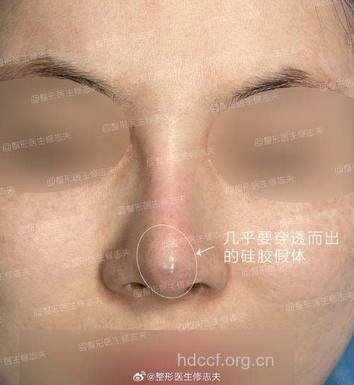 女子隆鼻后发现假体材料被掉包 两者相差三千元