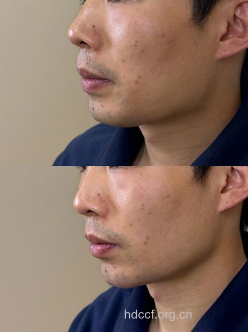 美容院男性点痣隆鼻渐多 称整形后更有自信